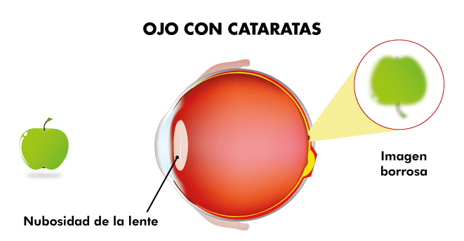 Visión ojo con cataratas Visión ojo con cataratas