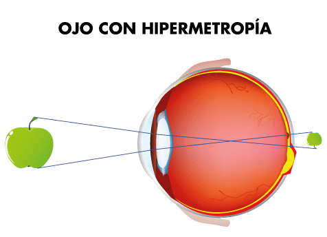 hipermetropia