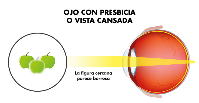Visión ojo con vista cansada o presbicia Visión ojo con vista cansada o presbicia