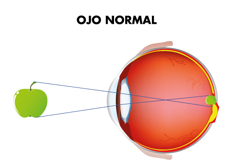 Visión ojo normal Visión ojo normal