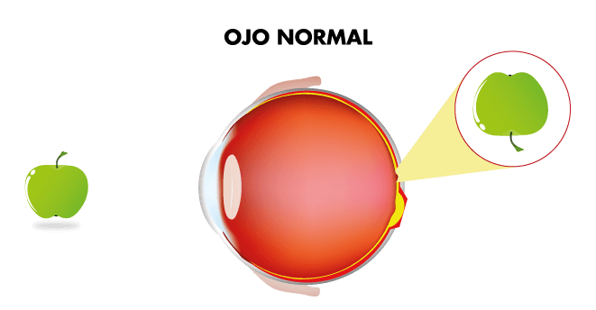 Visión ojo sin catarata Visión ojo sin catarata