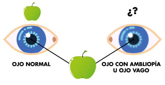 Visión ojo vago o ambliopía Visión ojo vago o ambliopía