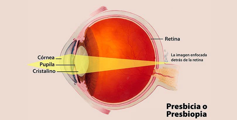 Síntomas y operación para la vista cansada o presbicia