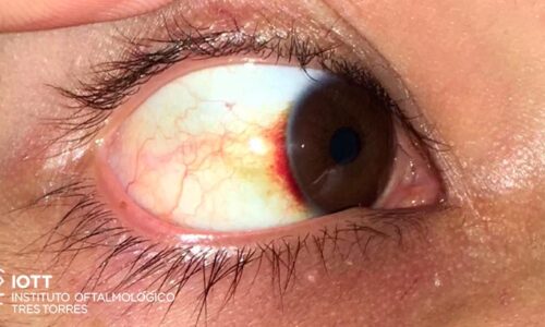 derrame ocular 2