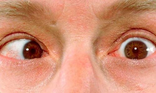 nistagmus o nistagmo